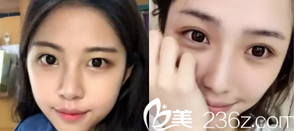 德州友谊医院全切双眼皮案例