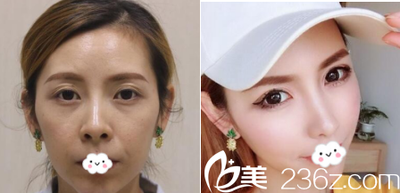 德州友谊医院隆鼻案例