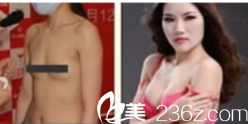 德州友谊整形医院隆胸案例