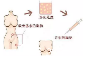 自体脂肪隆胸示意图