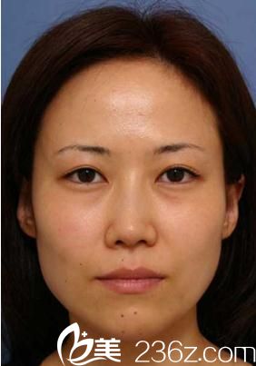 福田庆三全切双眼皮前 福田庆三全切双眼皮前