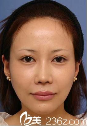 在日本美真美容的福田庆三医生那里做了切开双眼皮，我也有了明眸善睐