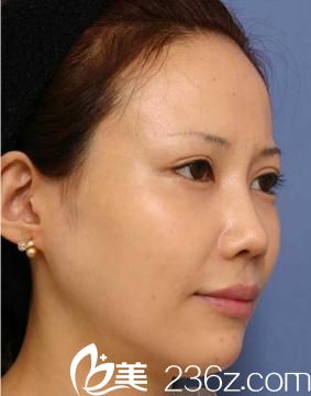 福田庆三全切双眼皮术后侧面展示 福田庆三全切双眼皮术后侧面展示