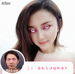 我在湛美整形医院做面部自体脂肪填充后的样子