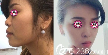 北京煤医整形李敏面部轮廓塑形