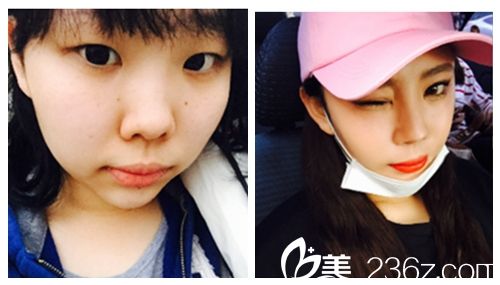 韩国ID医院微创全切双眼皮术前术后对比图