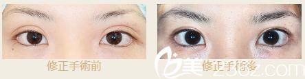 池本繁宏双眼皮变窄修复 池本繁宏双眼皮变窄修复