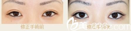 池本繁宏眼睑下垂修正 池本繁宏眼睑下垂修正