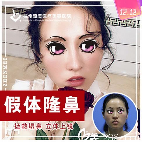 浙江做隆鼻手术的价格是多少钱?杭州甄美王辉和黄江主刀硅胶隆鼻手术费用2800元起