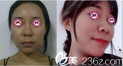 <!--<i data=20240703-sp></li>
<li><i data=20240703-sp></i>-->现卓颜蕊丽李文波面部自体脂肪填充案例