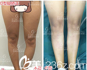 <!--<i data=20240703-sp></li>
<li><i data=20240703-sp></i>-->现卓颜蕊丽赵禹翔O型腿矫正案例