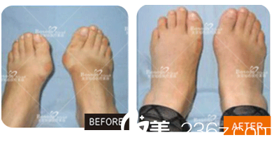 <!--<i data=20240703-sp></li>
<li><i data=20240703-sp></i>-->现卓颜蕊丽赵禹翔大脚骨美足术案例