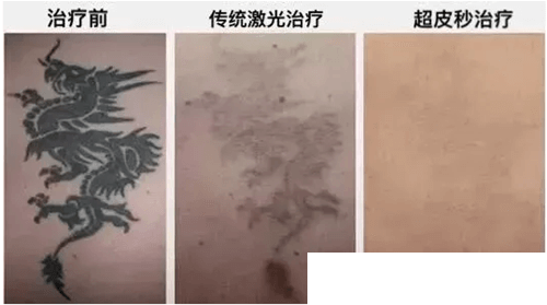 宜春天泽整形医院祛除纹身案例