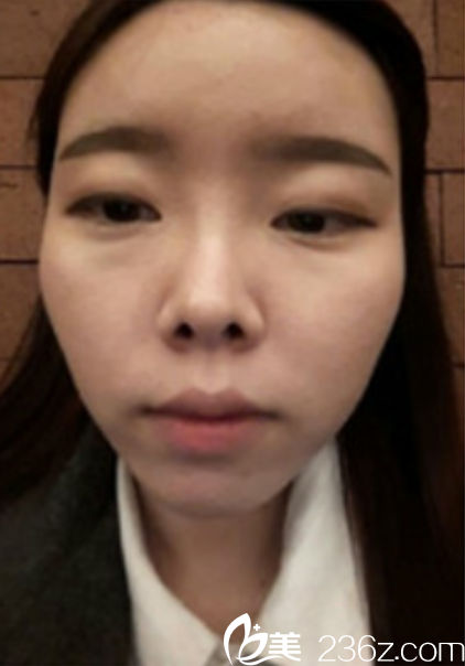 韩国新帝瑞娜面部轮廓+鼻修复手术术前 韩国新帝瑞娜面部轮廓+鼻修复手术术前