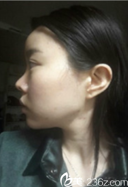 韩国新帝瑞娜面部轮廓+鼻修复手术术前