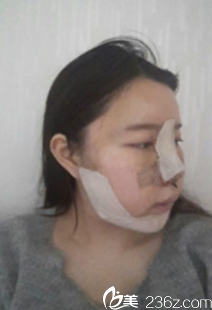 韩国新帝瑞娜面部轮廓+鼻修复手术术后第2天 韩国新帝瑞娜面部轮廓+鼻修复手术术后第2天
