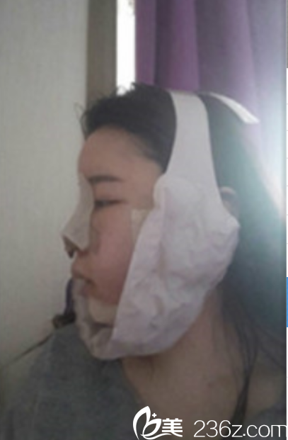 韩国新帝瑞娜面部轮廓+鼻修复手术术后第2天
