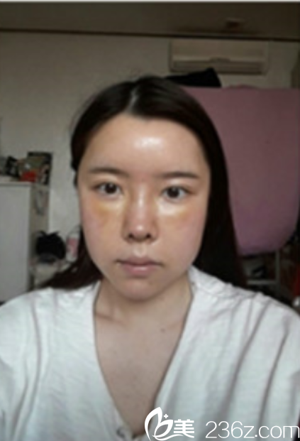 韩国新帝瑞娜面部轮廓+鼻修复手术术后第7天 韩国新帝瑞娜面部轮廓+鼻修复手术术后第7天