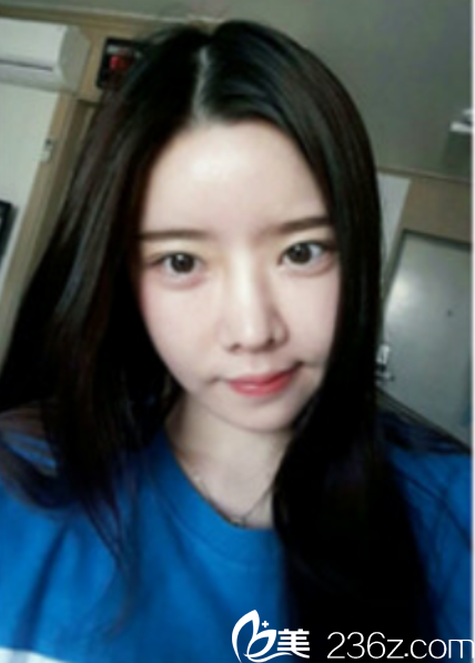 韩国新帝瑞娜面部轮廓+鼻修复手术术后第30天