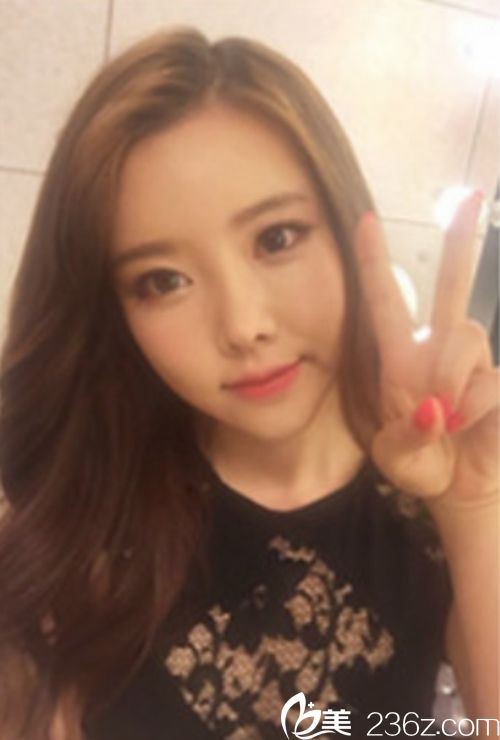 韩国新帝瑞娜面部轮廓+鼻修复手术术后第120天 韩国新帝瑞娜面部轮廓+鼻修复手术术后第120天