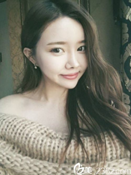 韩国新帝瑞娜面部轮廓+鼻修复手术术后第330天 韩国新帝瑞娜面部轮廓+鼻修复手术术后第330天