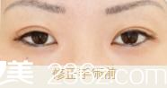 池本繁医生的高超双眼皮修复 池本繁医生的高超双眼皮修复