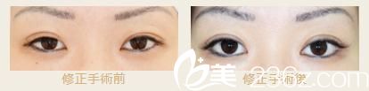 池本繁医生的高超双眼皮修复对比照片 池本繁医生的高超双眼皮修复对比照片