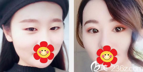 呼和浩特五洲全切双眼皮+开内眼角效果案例 呼和浩特五洲全切双眼皮+开内眼角效果案例