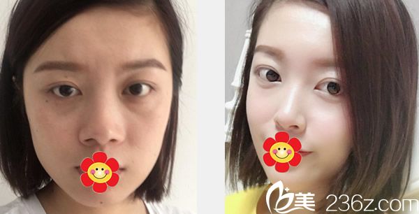 五洲王焕医生玻尿酸丰面颊+自体软骨综合隆鼻前后效果对比图 五洲王焕医生玻尿酸丰面颊+自体软骨综合隆鼻前后效果对比图