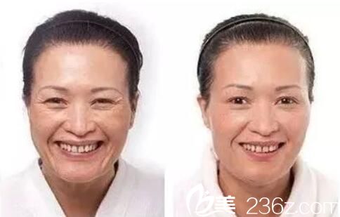 洛阳华美瘦脸除皱注射除皱