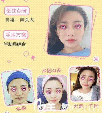 南通维多利亚鼻综合效果图 南通维多利亚鼻综合效果图