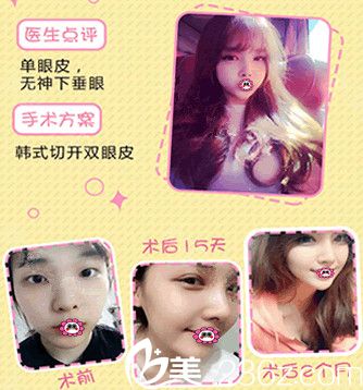 南通维多利亚做双眼皮变化图 南通维多利亚做双眼皮变化图