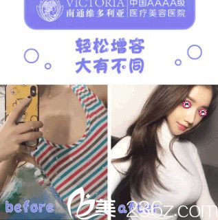 南通维多利亚沈正洲隆胸前后对比图 南通维多利亚沈正洲隆胸前后对比图
