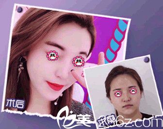 我在南通维多利亚做完线雕V脸后变得更美了 我在南通维多利亚做完线雕V脸后变得更美了