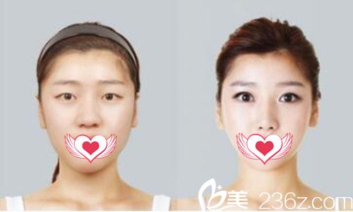 佛山华美割双眼皮案例效果对比 佛山华美割双眼皮案例效果对比