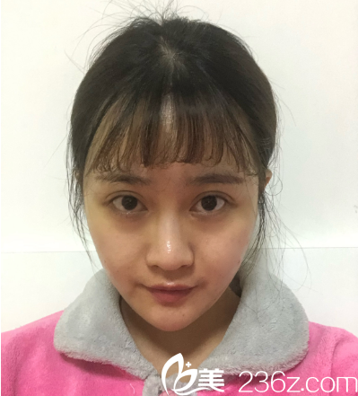 深圳非凡易培金全切双眼皮7天拆线图片 深圳非凡易培金全切双眼皮7天拆线图片