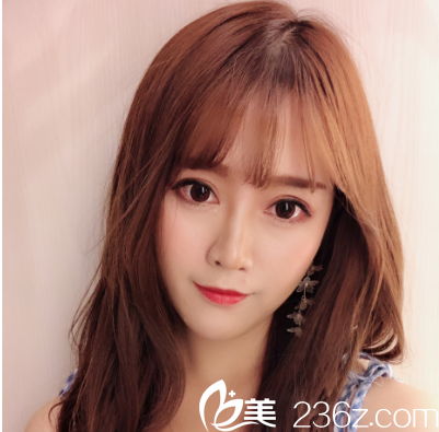 深圳非凡易培金做的双眼皮案例15天照片 深圳非凡易培金做的双眼皮案例15天照片