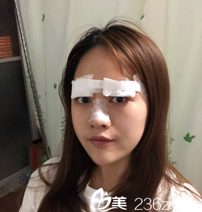 找易培金做完双眼皮术后天 找易培金做完双眼皮术后天