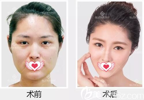 郑裕锡面部五官综合打造真人效果对比