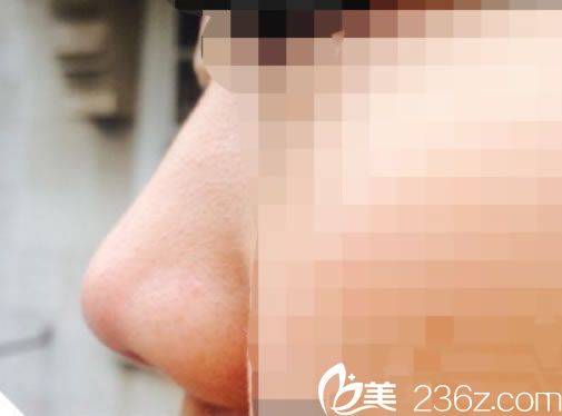 无锡施尔美李雄艳注射玻尿酸隆鼻案例 1ml玻尿酸成功摆脱塌鼻梁