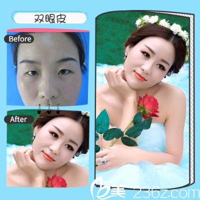 深圳非凡12月年终特惠整形价格表 丁锋梅够明双眼皮隆鼻1680元附案例