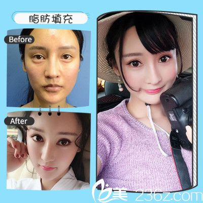 深圳非凡王永祥做的自体脂肪面部填充案例 深圳非凡王永祥做的自体脂肪面部填充案例