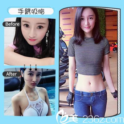 深圳非凡黄纯医生吸脂真人案 深圳非凡黄纯医生吸脂真人案