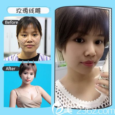 深圳非凡张佳佳做的面部线雕提升案例 深圳非凡张佳佳做的面部线雕提升案例