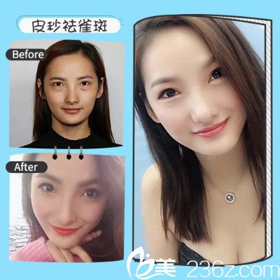 深圳非凡腾传远做的超皮秒祛斑案例 深圳非凡腾传远做的超皮秒祛斑案例