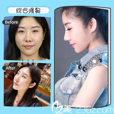 深圳非凡梅够明做的隆鼻案例 深圳非凡梅够明做的隆鼻案例