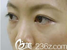 祛眼袋手术前侧面展示