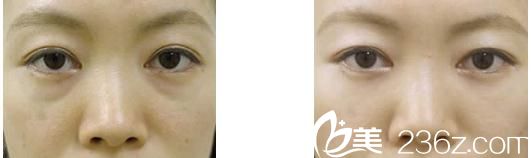 去眼袋手术前后对比