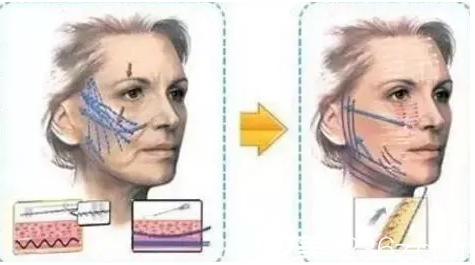 长春瑞丽线雕提升贵不贵？看一下瑞丽2018年年优惠价格线雕12580元起