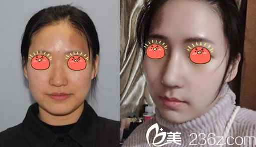 宁波薇琳张潮肋软骨鼻综合案例 宁波薇琳张潮肋软骨鼻综合案例